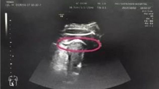 Una mujer estuvo a punto de morir luego de que su bebé le perforó el útero de una patada