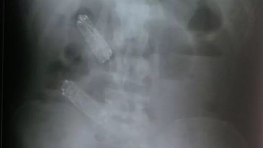 Brasil: un preso se tragó tres celulares y murió una semana después