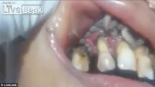 Video escalofriante: el momento en que un dentista se enfrenta a una boca repleta de gusanos