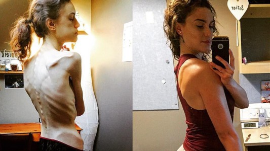 Las duras imágenes de una joven que padeció anorexia y asegura que Instagram le salvó la vida