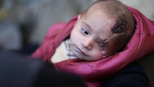 La historia de Karim, el bebé sirio que perdió un ojo y se convirtió en símbolo de la resistencia
