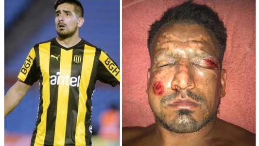 Dos meses de recuperación tendrá Lucas Viatri tras el accidente con pirotecnia