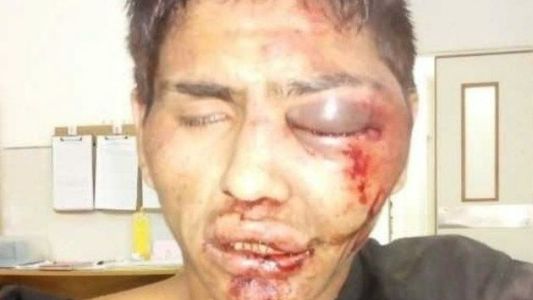 Robó un celular y le desfiguraron la cara a golpes