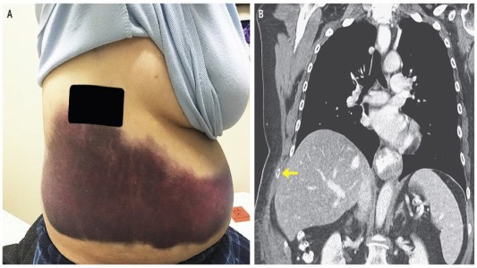 Una mujer se quebró una costilla al sufrir un ataque de tos