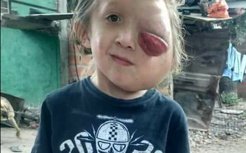 Todos por Tobías: tiene un gran tumor en la cara y necesita ayuda para pagar su tratamiento