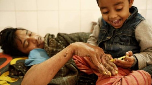 La historia del paciente que tiene pánico de volver a convertirse en el "hombre árbol"
