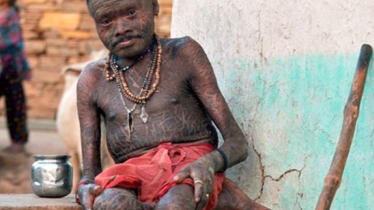 El extraño caso del “hombre serpiente” que cambia la piel cada 10 días