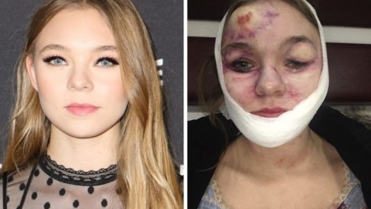 Actriz quedó desfigurada durante la filmación de una película