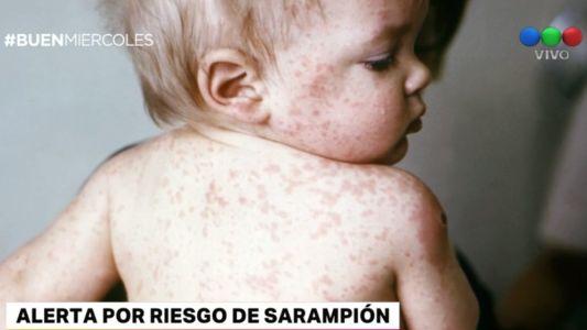 Emiten un alerta por el riesgo de que vuelva el sarampión a la Argentina