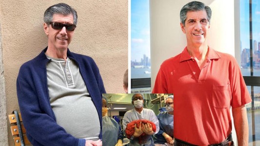 Pensó que estaba gordo, fue al médico y le terminaron extirpando un tumor de 13 kilos del estómago