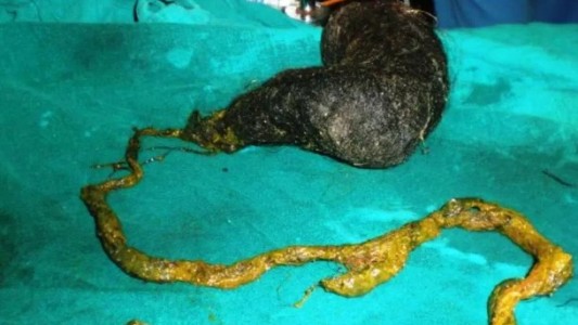 India: una nena fue internada por dolores de panza y le extrajeron del estómago dos kilos de pelos