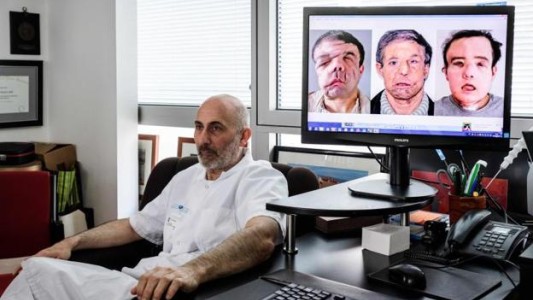 Trasplante inédito: el hombre de las tres caras
