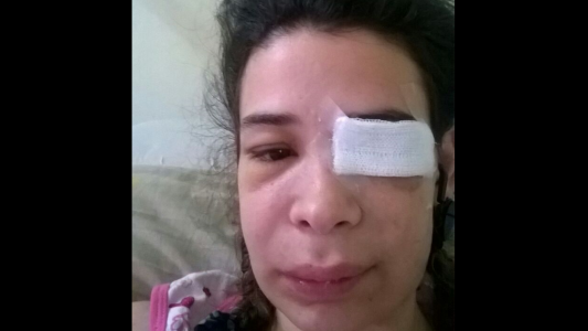 Su expareja policía le sacó un ojo y sigue amenazándola: “Vivo con miedo todo el tiempo"