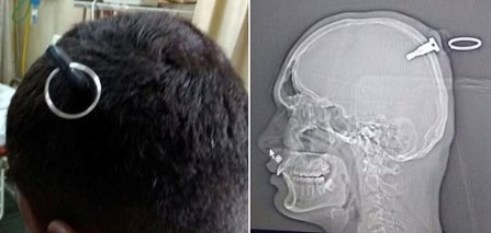 El joven indio que sobrevivió con una llave de cuatro centímetros clavada en la cabeza
