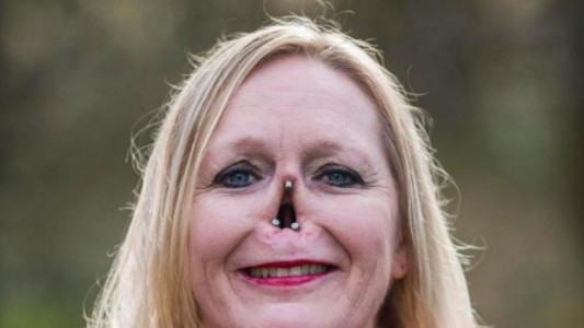 La prótesis magnética que ayuda a vivir a la mujer sin nariz