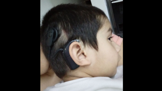 Un nene hipoacúsico de 4 años necesita ayuda para comprar un audífono