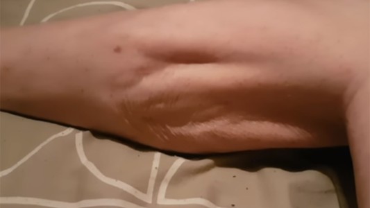 Video impresionante: así afecta un calambre a los músculos del cuerpo