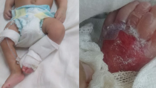 Denuncian que un bebé con un tumor en la cabeza fue quemado en un hospital de Moreno