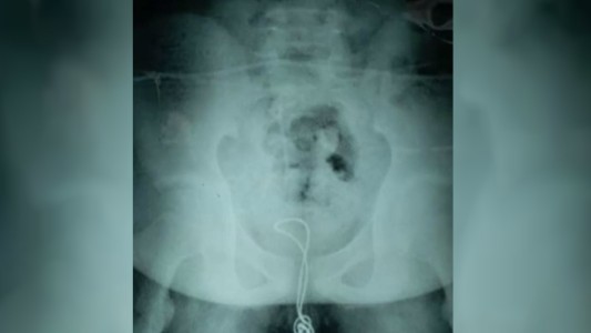 Un joven chino se metió un cable USB por el pene y tuvo que ser operado