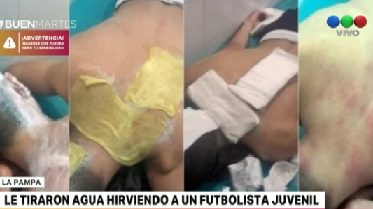 La Pampa: le tiraron agua hirviendo a un futbolista juvenil