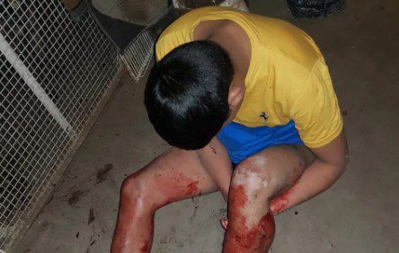 Entró a robar a la casa de una jubilada y un pitbull le destrozó la pierna