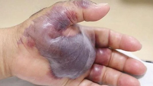 Le agarró una infección por comer sushi y tuvieron que amputarle el brazo