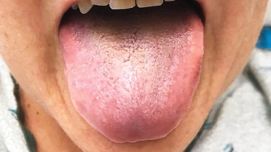 Un antibiótico hizo que mutara su lengua: se le puso negra, peluda y con mal olor