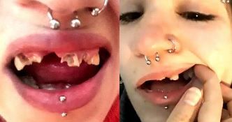 Joven denuncia mala praxis odontológica: perdió los dientes, aumentó 50 kilos y llora de dolor