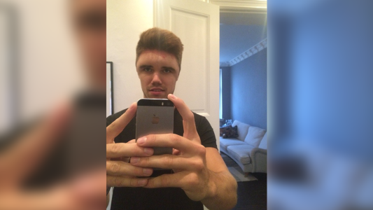 El terrible caso del joven que se tiñó el pelo y terminó con la cabeza hinchada