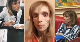 El cruel comentario de un médico a una mujer que sufre anorexia y pesa 17 kilos