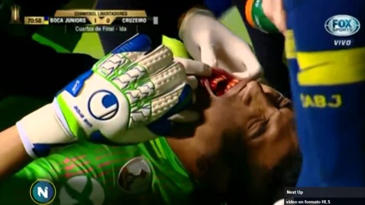 Andrada, el arquero de Boca, tiene fractura de mandíbula