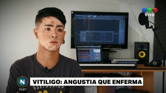 Vitiligo: historias detrás de la angustia que enferma