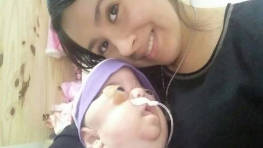Madre de la única beba argentina con síndrome de Beare-Stevenson : "Juliana me ha enseñado a vivir cada día"