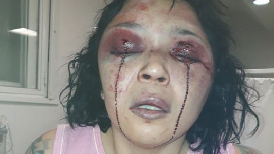 El fuerte relato de una mujer que fue brutalmente golpeada con un hierro por su expareja
