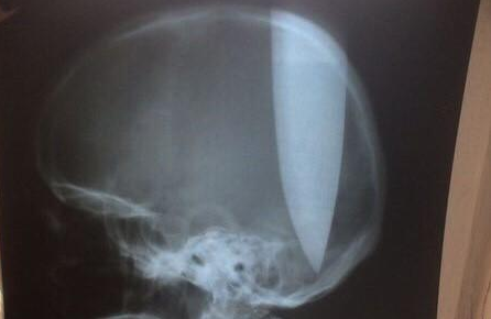 Un hombre se clavó un cuchillo de 20 centímetros en la cabeza para "poder respirar"