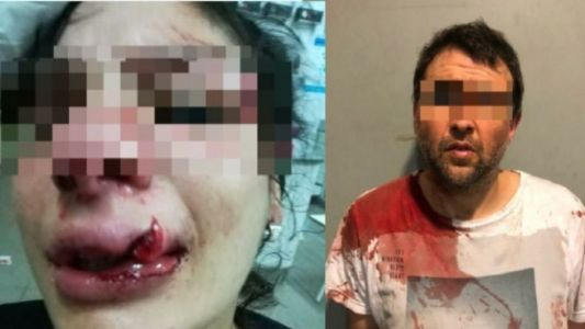 En un ataque de celos golpeó con el casco de la moto a su novia hasta desfigurarla