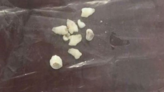 Extraen dientes sueltos del cerebro de un nene de 5 años