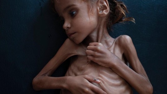 Murió Amal, la nena símbolo de la hambruna de Yemen