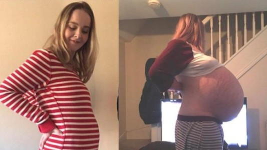 Los doctores pensaron que estaba embarazada, pero tenía un quiste de 26 kilos