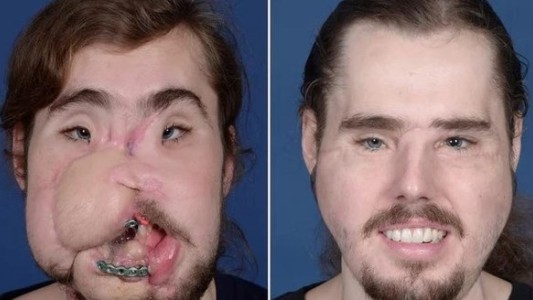 El asombroso trasplante de cara que le cambió la vida a un joven de 26 años