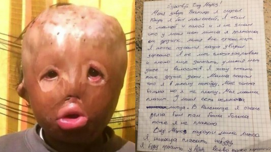 El nene de 5 años que sufrió quemaduras y le pide a Papá Noel "una cara nueva"