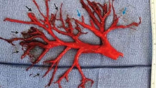 El increíble coágulo de sangre que tosió un paciente en Estados Unidos