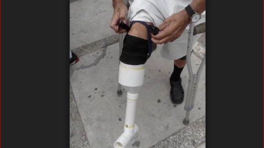 Se armó su propia prótesis para poder seguir trabajando
