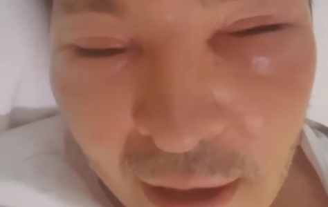 El drama de Guido Suller: está internado con la cara desfigurada