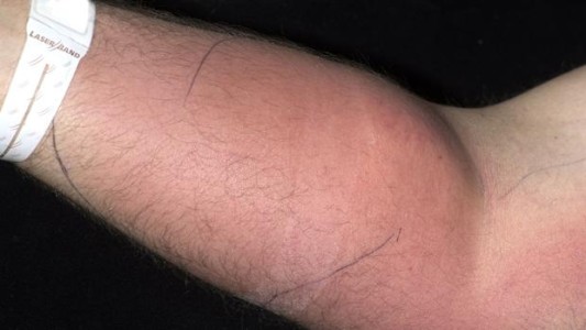 El curioso caso del hombre que se inyectaba semen en el brazo por sus dolores de espalda