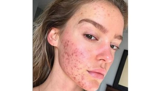 El secreto de esta joven modelo para combatir el acné de su cara