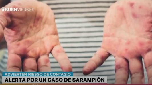 Detectan un caso de sarampión: un turista ruso que estuvo en Argentina