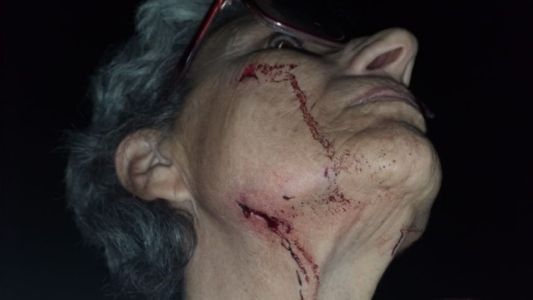 Una mujer fue atacada por los pitbull de su vecino y le arrancaron parte de la oreja