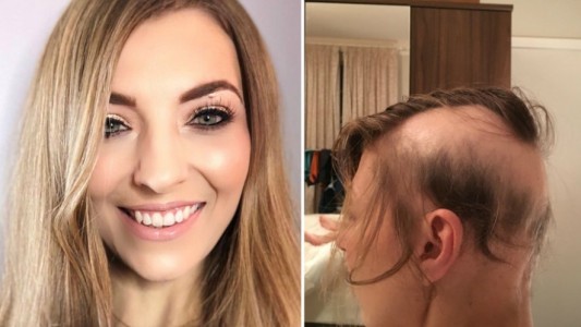 La mujer que se quedó pelada por el estrés que le causó su casamiento