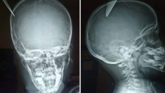Estaban jugando y un nene le clavó un cuchillo en la cabeza a su amigo de 5 años